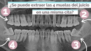 ¿SE PUEDEN EXTRAER LAS 4 MUELAS DEL JUICIO EN UNA MISMA CITA [upl. by Lionel]