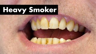 Cleaning Smokers Teeth with Heavy Stain  Teeth Cleaning [upl. by Aerdnahs689]