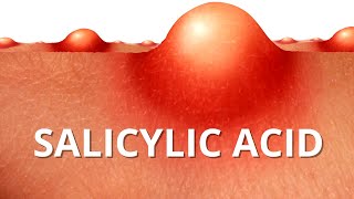 Heres WHY Salicylic Acid is Best For ACNE [upl. by Winne]