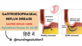 Gastroesophageal reflux disease in hindi  GERD  Cause  Symptom  Treatment  Acid reflux in hindi [upl. by Inna]