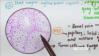 Histopathology of Renal Cell Carcinoma [upl. by Parhe74]