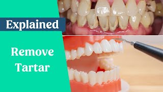 How to remove tartar from teeth without a dentist [upl. by Daeriam]