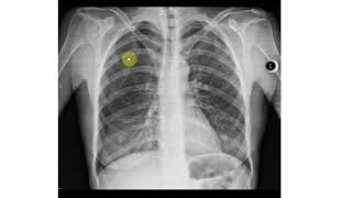 Pneumothorax Röntgen Beispiele erklärt [upl. by Fiske]