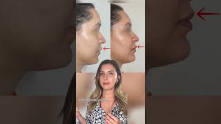 Facial Balancing with fillers  Dr MediSpa [upl. by Erl824]