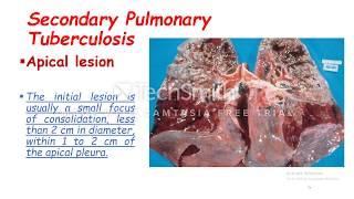 Secondary Pulmonary Tuberculosis [upl. by Winshell]