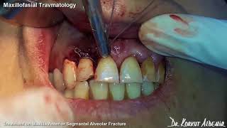 Maxillofacial Travmatology  Treatment On Maxilla Anterior Segmental Aveolar Fracture [upl. by Kreiner432]