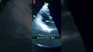 Moderate Mitral Stenosis mitral valve shorts heartknowledge cathlab [upl. by Wurster956]