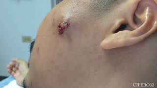 Large Infected Sebaceous cysts Left Face Removal [upl. by Meelak]