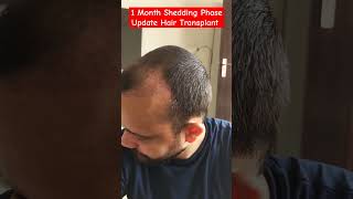 1 Month Shedding Phase Update After DHI Hair Transplant hair hairtransplant [upl. by Mohn412]