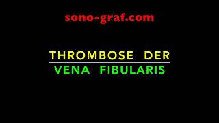 008  Duplexsonographie  Thrombose der Vena fibularis [upl. by Aerised]