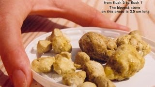 Liver Detoxify Gall Stone Cleanse Removal Of Gallstones Gallstone Attacks [upl. by Adnert]