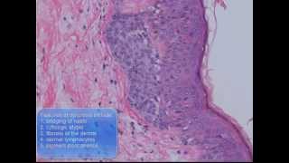 Melanocytic lesions [upl. by Asin]