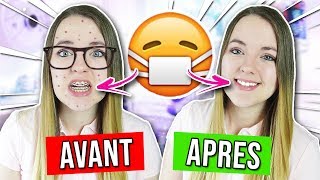 AVOIR UN APPAREIL DENTAIRE  AVANT VS APRES [upl. by Tice]