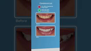 Opalescence™ Boost™ and Opalescence Go™  Case Study [upl. by Ishmael]