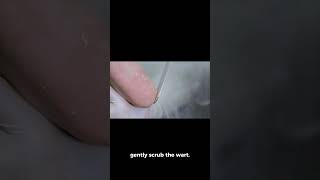 Eliminate warts using duct tape hack [upl. by Iadrahs]