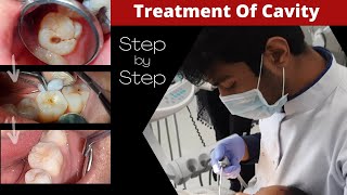 Composite Filling Step by Step  Cavity In Tooth  How To Fill Decayed Tooth  Dr Sunil Kumar [upl. by Okier]