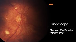 Diabetic Proliferative Retinopathy Fundoscopy [upl. by Ahtnammas]