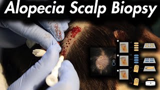 Hair Loss Consider a Scalp Biopsy [upl. by Boarer]