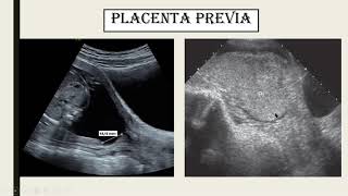 Ultrasonido Obstétrico del segundo semestre [upl. by Lefton481]