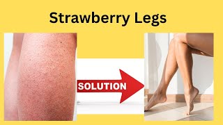 Strawberry Legs Solution  Malayalam [upl. by Leamse]