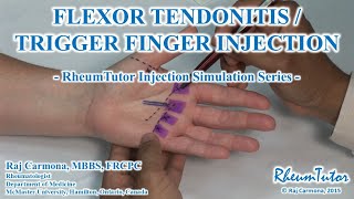 FLEXOR TENDONITIS  TRIGGER FINGER INJECTION  Simulation Series [upl. by Riddle]