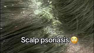 Scalp Psoriasis Removal [upl. by Llebiram102]