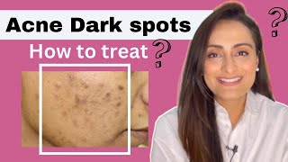 Acne Dark Spots  हिंदी  How to treat  serum cream recommendations  Dermatologist  Dr Aanchal [upl. by Anilasor]