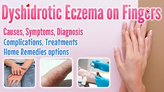 Dyshidrotic eczema on fingers overview causes symptoms treatment options and home remedies [upl. by Zadoc]