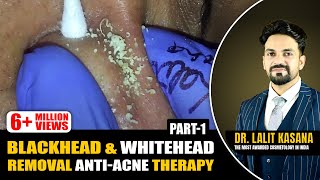 BLACKHEAD amp WHITEHEAD REMOVAL ANTIACNE THERAPY PART  1 [upl. by Niltak597]