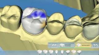 CEREC SW 40 Overview from Beta Testers [upl. by Adnaloj]