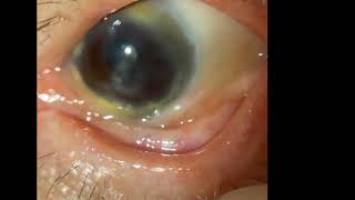 Ocular Cicatricial Pemphigoid [upl. by Waxman]