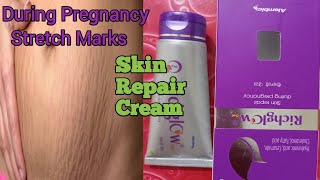 Stretch Marks Removal Guide l Simple Ways To Teat Stretch Marks l Stretch Marks Removal Cream l [upl. by Bowman147]