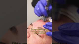 Hows a Micro Needling Skin Treatment microneedling [upl. by Blanding]