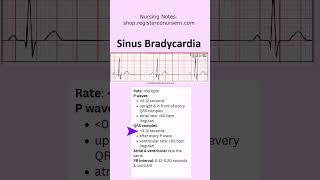 Sinus Bradycardia ECG EKG Nursing Treatment Rhythm Made Easy in Less Than 1 Minutes nursing ecg [upl. by Aciretal]