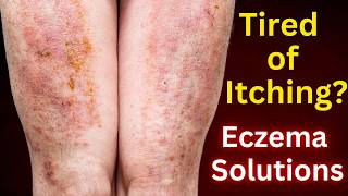 Dermatologist’s Guide to Beating Eczema [upl. by Godderd]