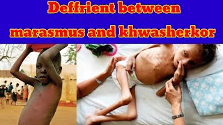 deffrient between marasmus and kwashiorkor  kwashiorkor vs marasmus pashto [upl. by Earl313]