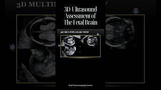 3D Ultrasound Assessment of The Fetal Brain [upl. by Esinal824]