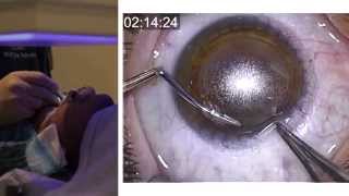 London Vision Clinic  ReLEx SMILE  Live laser eye surgery  Professor Dan Reinstein [upl. by Orvan]