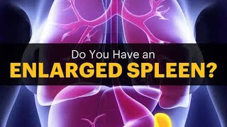 Splenomegaly Enlarged Spleen Splenitits Treatment and Cure [upl. by Aynotahs]