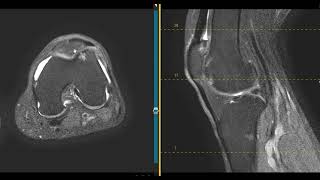 Knee pain in 63 year old grandmother [upl. by Gurney]