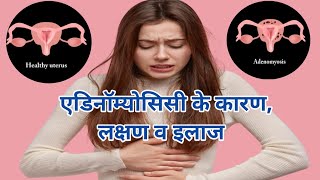 एडिनॉम्योसिस क्या होता है इसके लक्षण क्या होते है व इसके बचाव Adenomyosis Symptoms and Causes [upl. by Eberle]