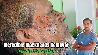 7YearOld Giant Blackhead Extraction Needle Method Revealed  alliedhealthscience skincare [upl. by Anair]