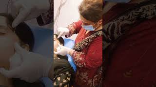 Subcision treatment for acne marks By Dr Tayyaba Tahir  drtayyabatahir AcneScarTreatment fyp [upl. by Sybilla]