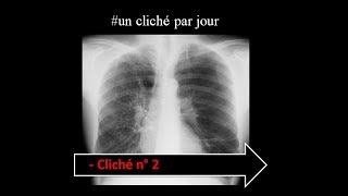 unclichéthoraciqueparjour  interprétation radiologique type emphysème pulmonaire diffus [upl. by Annora673]