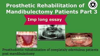 Prosthetic Rehabilitation Of Mandibulectomy Patient  Part 3 [upl. by Anuala]