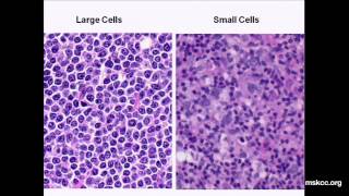 What You Need to Know about NonHodgkins Lymphoma Presentation [upl. by Jed]