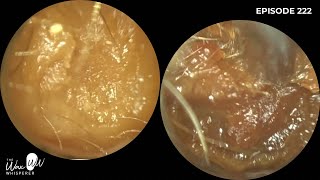 222  Very Blocked Ear Wax Removal using the WAXscope®️ [upl. by Etteuqaj]