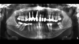 für Zahnärzte das OPTG Röntgen [upl. by Htebsle]