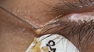 Extraction profonde des points noirs Acné kystique et popping 13 [upl. by Saw]