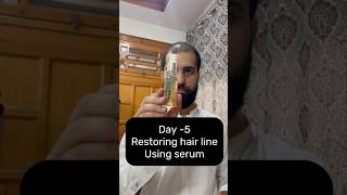 Restoring Hair Line Day5 using serum hairregrowth haircareroutine [upl. by Terrej]